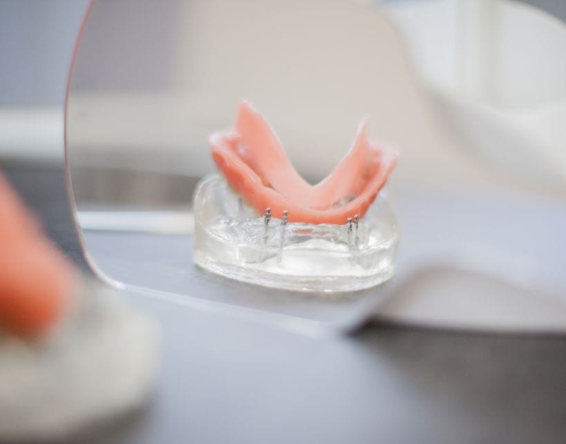 chi non può fare impianti dentali