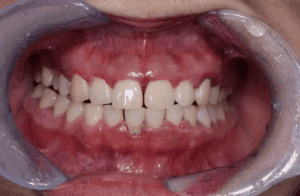 come prevenire la paradontite, che cosa è la paradontite e come curarla