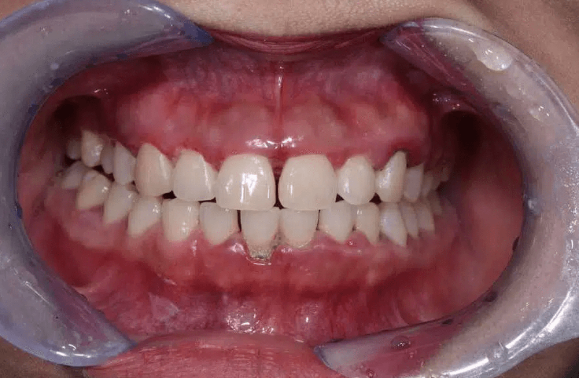 come prevenire la paradontite, che cosa è la paradontite e come curarla